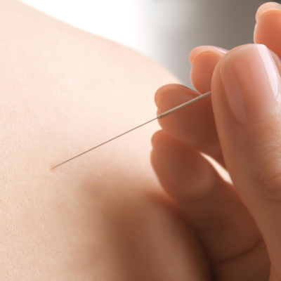 close-up van een dry needling behandeling in de schouder van een patiënt